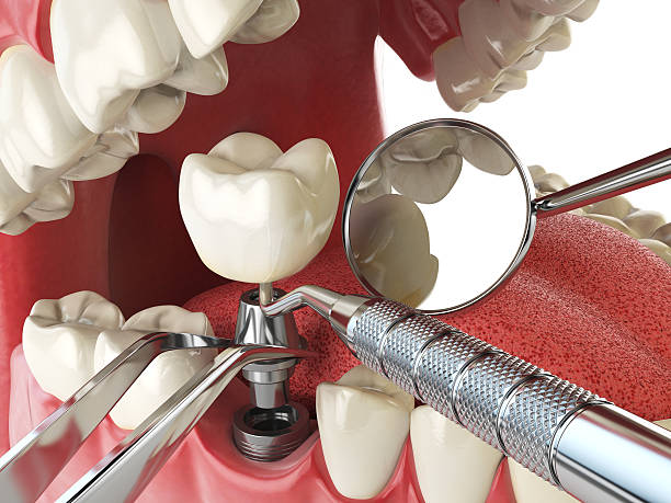 Best Emergency Denture Repair in Cerro Gordo, IL